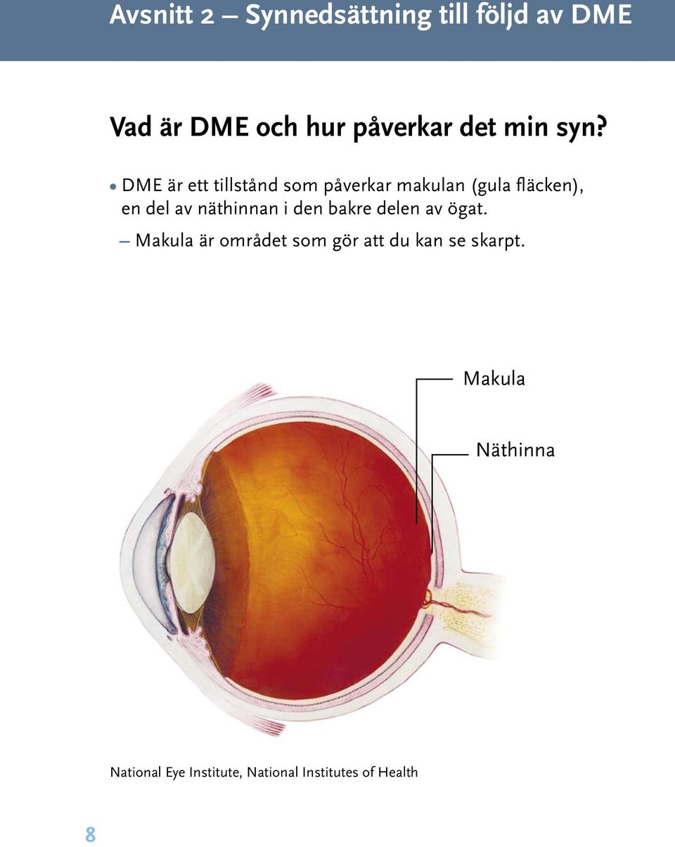 DME är ett tillstånd som påverkar makulan (gula fläcken), en del av