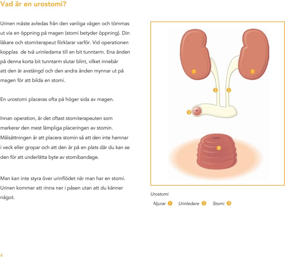 Ena änden på denna korta bit tunntarm slutar blint, vilket innebär att den är avstängd och den andra änden mynnar ut på magen för att bilda en stomi. En urostomi placeras ofta på höger sida av magen.
