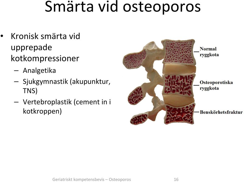 Sjukgymnastik (akupunktur, TNS) Vertebroplastik