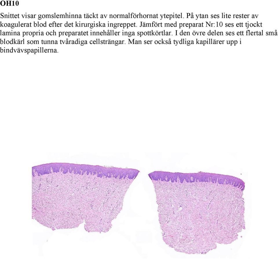 Jämfört med preparat Nr:10 ses ett tjockt lamina propria och preparatet innehåller inga