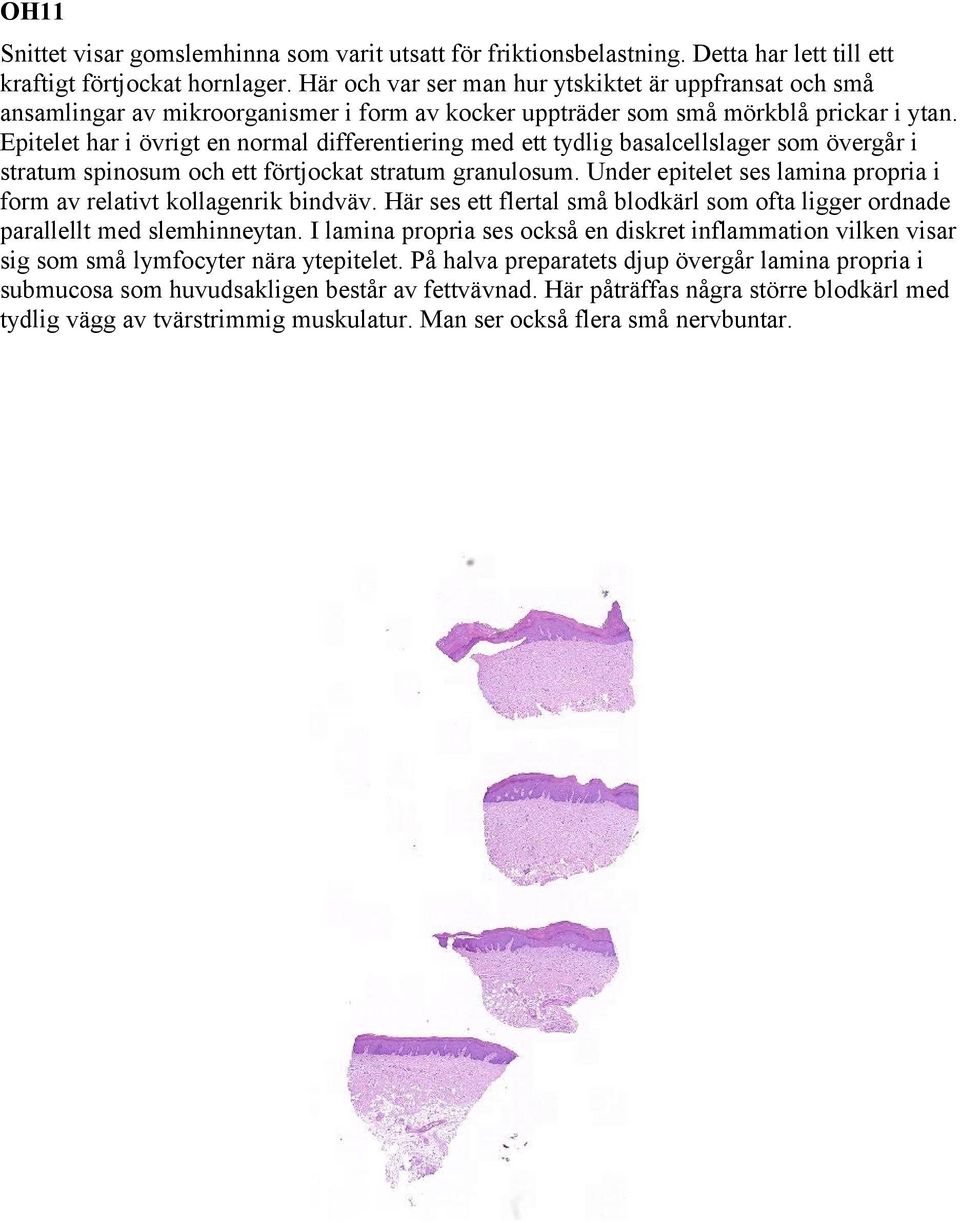 Epitelet har i övrigt en normal differentiering med ett tydlig basalcellslager som övergår i stratum spinosum och ett förtjockat stratum granulosum.