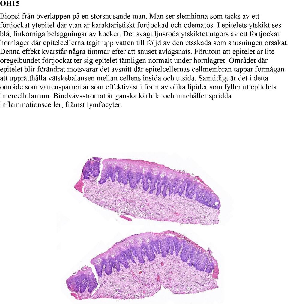 Det svagt ljusröda ytskiktet utgörs av ett förtjockat hornlager där epitelcellerna tagit upp vatten till följd av den etsskada som snusningen orsakat.