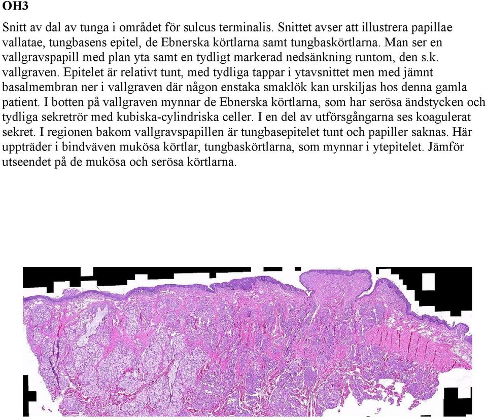 Epitelet är relativt tunt, med tydliga tappar i ytavsnittet men med jämnt basalmembran ner i vallgraven där någon enstaka smaklök kan urskiljas hos denna gamla patient.