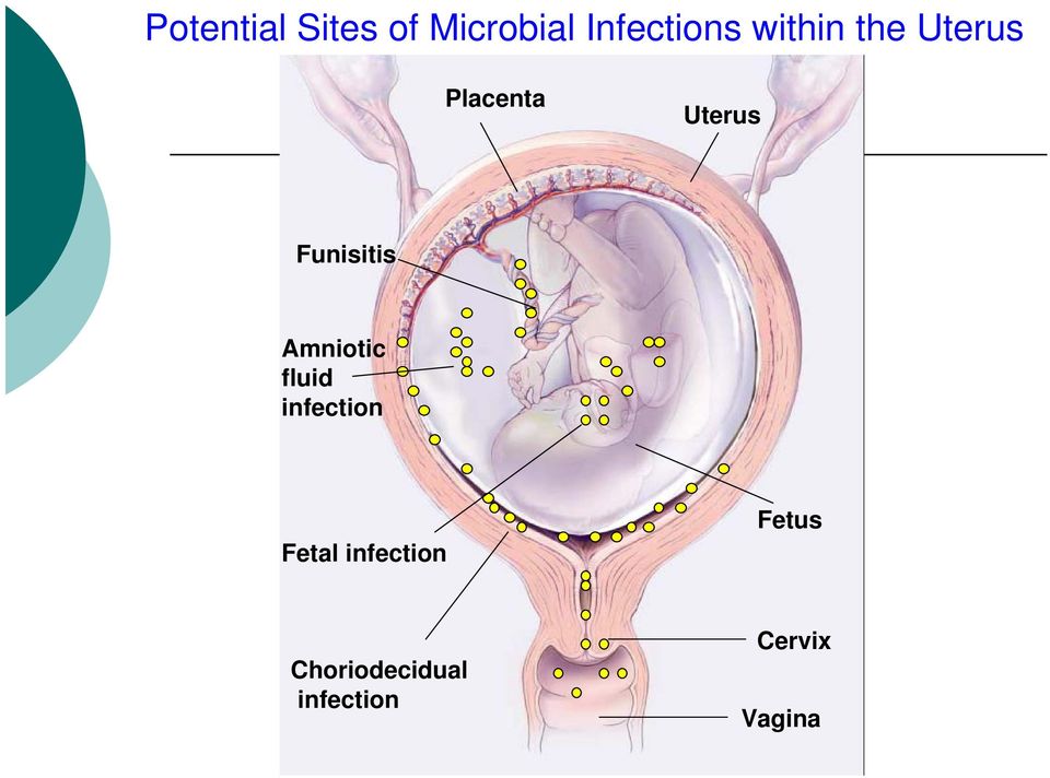 Funisitis Amniotic fluid infection Fetal