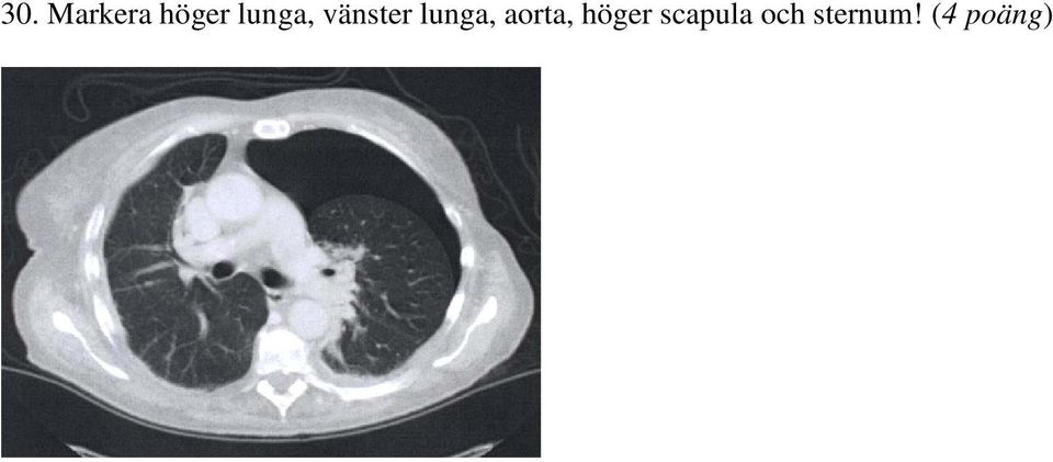 lunga, aorta, höger