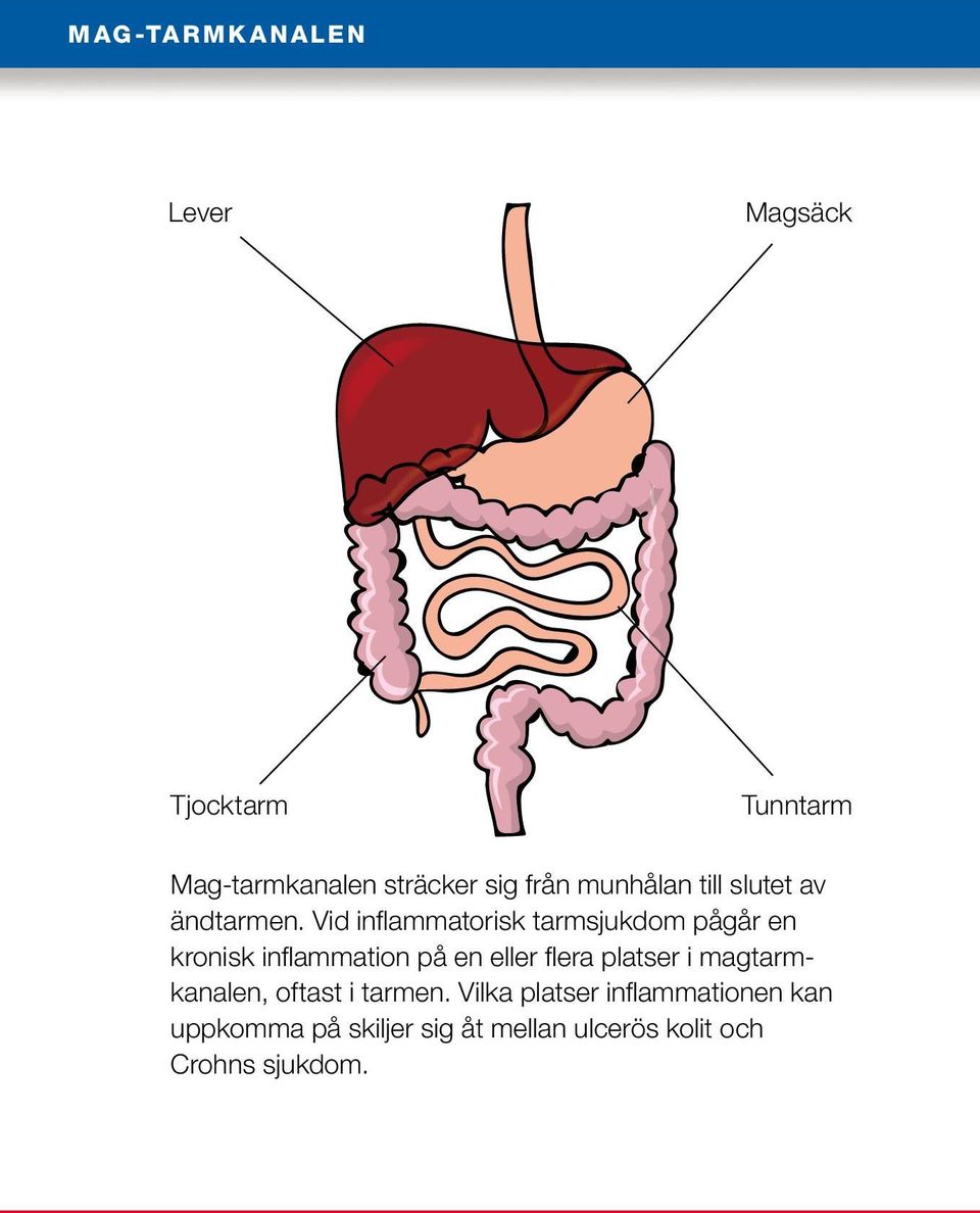 Vid inflammatorisk tarmsjukdom pågår en kronisk inflammation på en eller flera