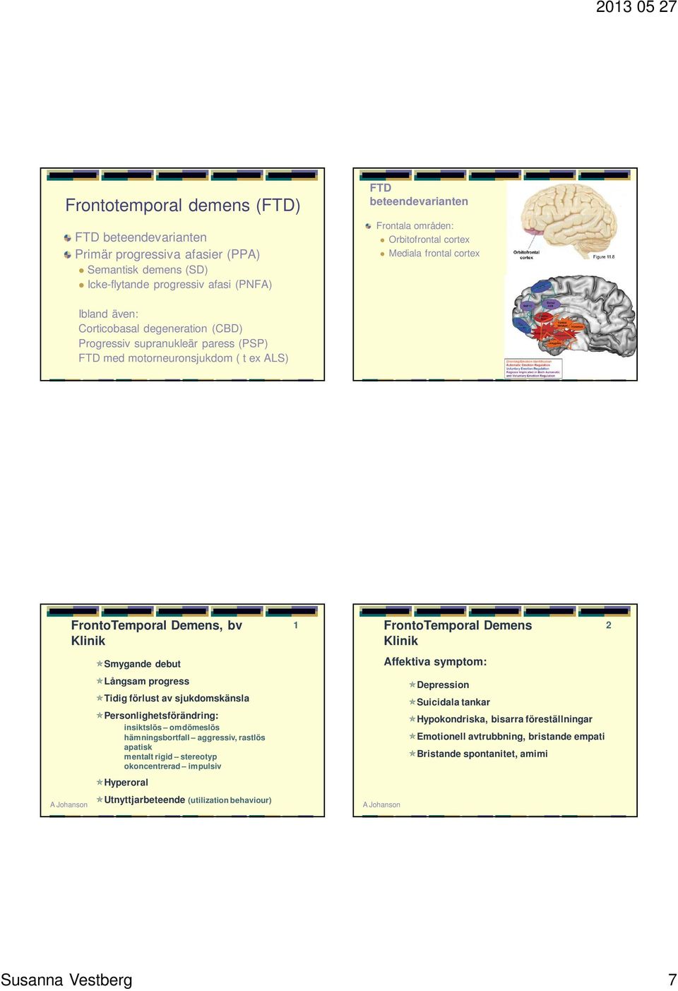 FrontoTemporal Demens Klinik 2 Smygande debut Affektiva symptom: Långsam progress Depression Tidig förlust av sjukdomskänsla Personlighetsförändring: insiktslös omdömeslös hämningsbortfall aggressiv,