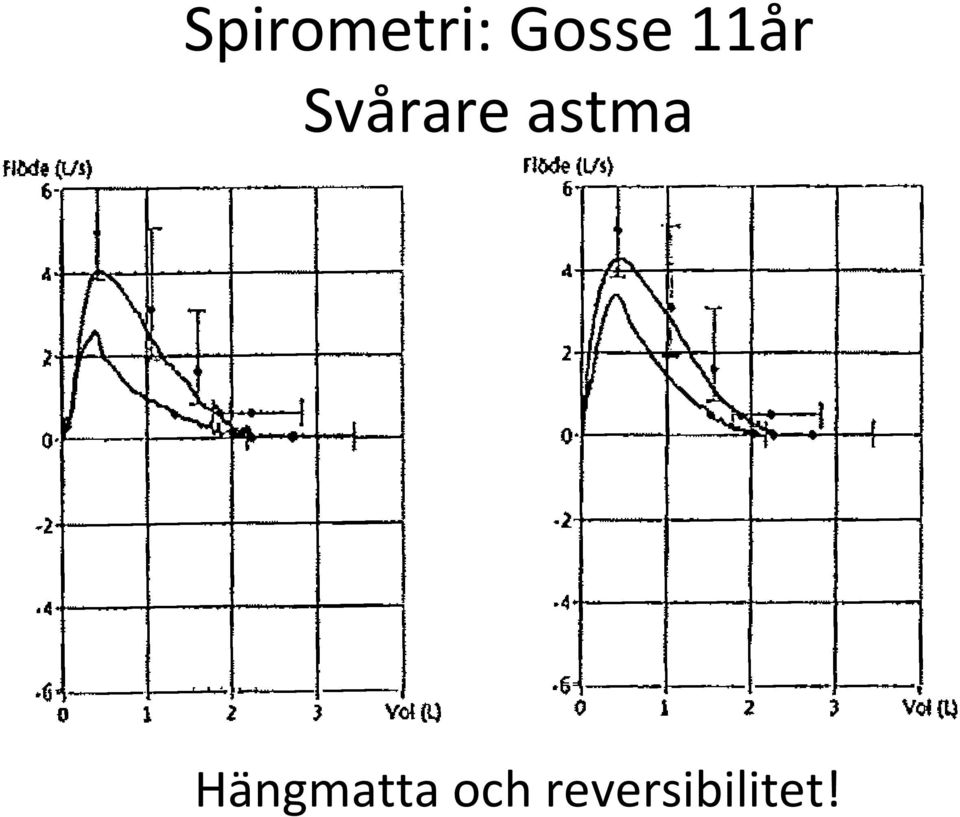 Svårare astma