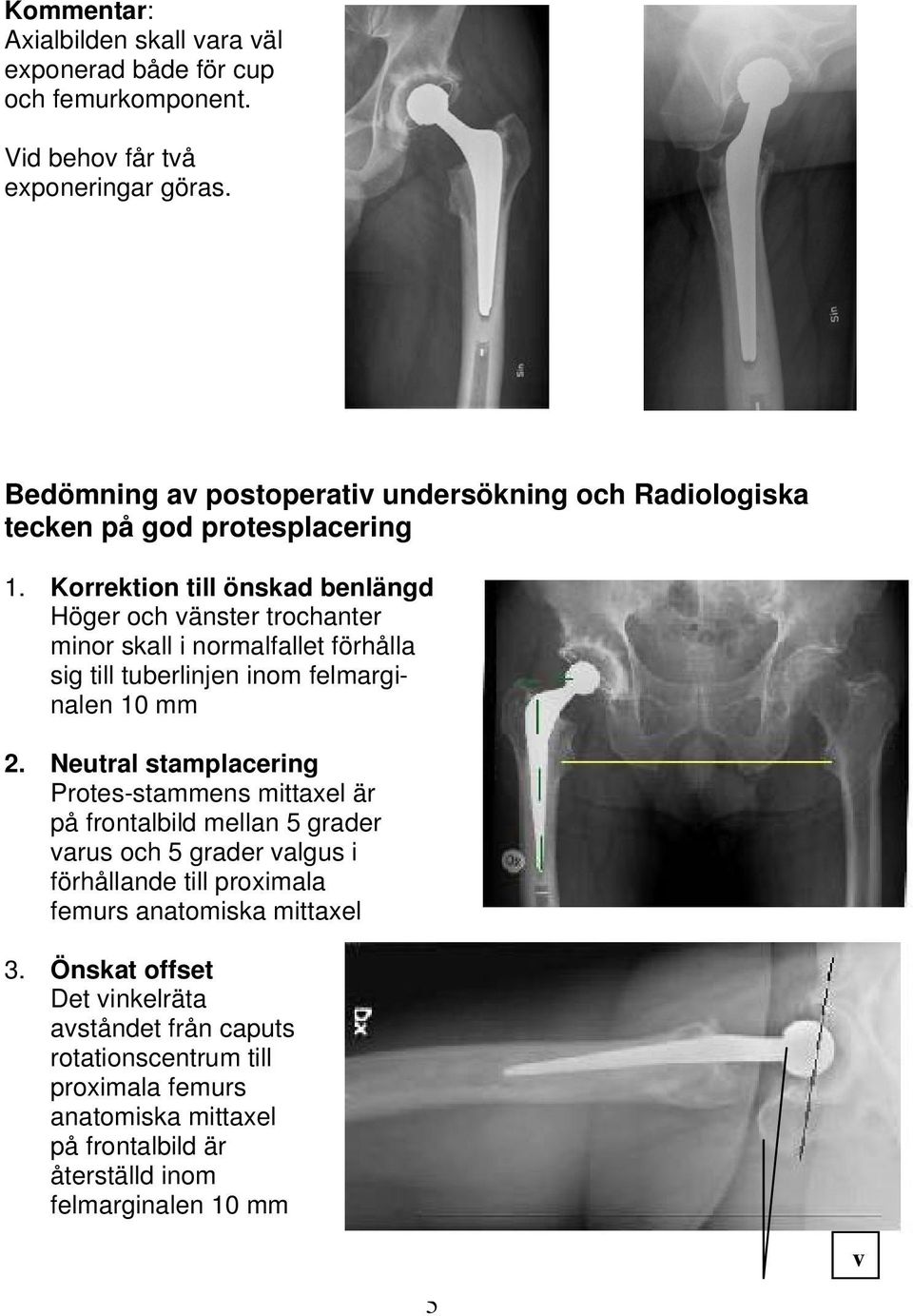 Korrektion till önskad benlängd Höger och vänster trochanter minor skall i normalfallet förhålla sig till tuberlinjen inom felmarginalen 10 mm 2.