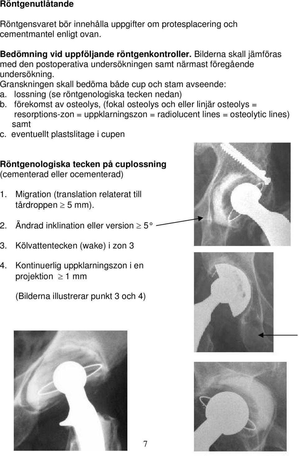 lossning (se röntgenologiska tecken nedan) b. förekomst av osteolys, (fokal osteolys och eller linjär osteolys = resorptions-zon = uppklarningszon = radiolucent lines = osteolytic lines) samt c.