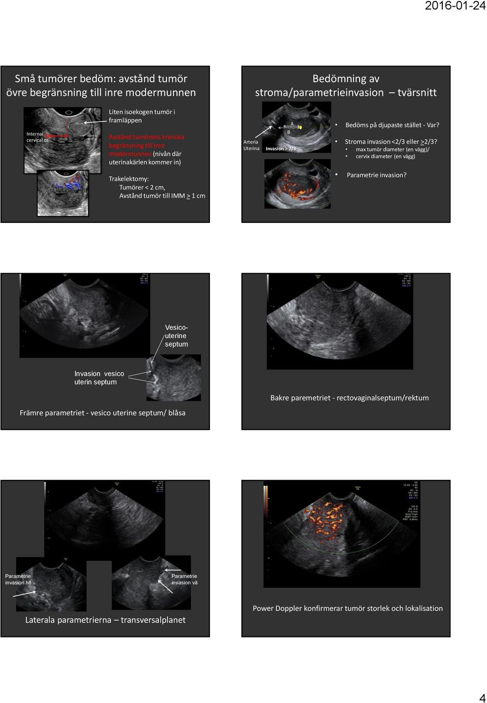 max tumör diameter (en vägg)/ cervix diameter (en vägg) Trakelektomy: Tumörer < 2 cm, Avstånd tumör till IMM > 1 cm Parametrie invasion?