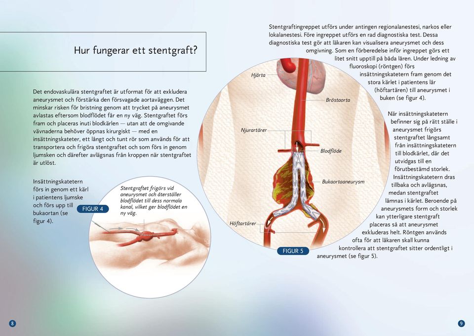 Stentgraftet förs fram och placeras inuti blodkärlen utan att de omgivande vävnaderna behöver öppnas kirurgiskt med en insättningskateter, ett långt och tunt rör som används för att transportera och