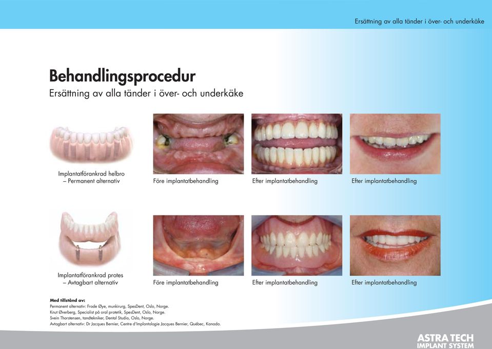 implantatbehandling Efter implantatbehandling Med tillstånd av: Permanent alternativ: Frode Øye, munkirurg, SpesDent, Oslo, Norge.