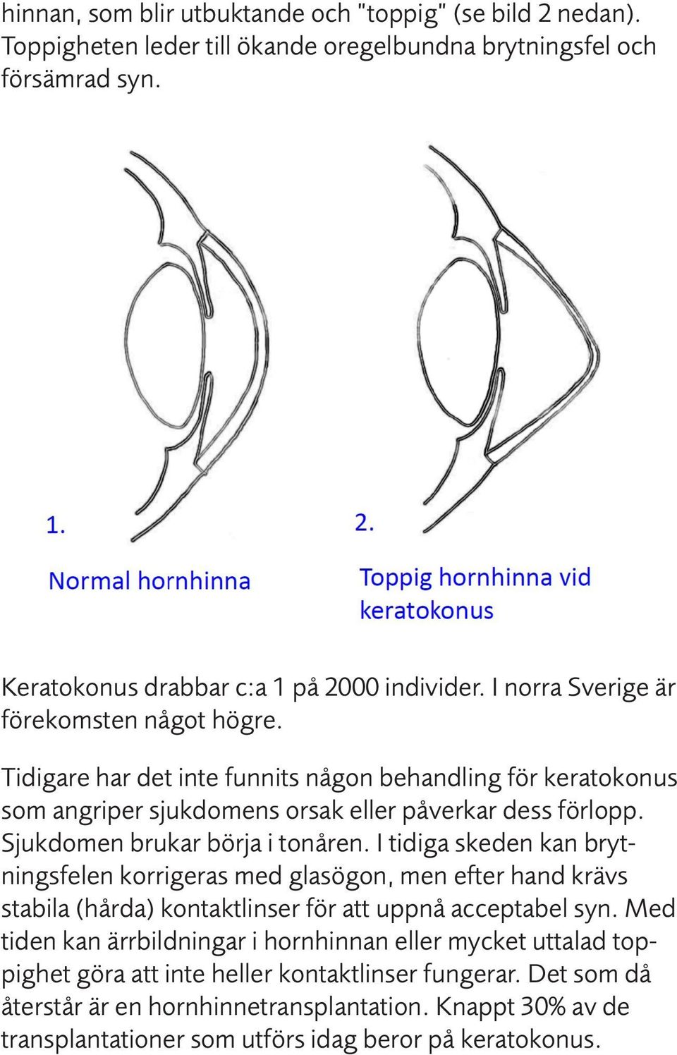 Sjukdomen brukar börja i tonåren. I tidiga skeden kan brytningsfelen korrigeras med glasögon, men efter hand krävs stabila (hårda) kontaktlinser för att uppnå acceptabel syn.