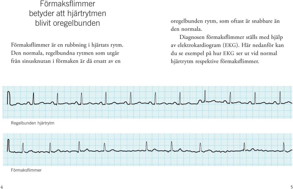 oftast är snabbare än den normala. Diagnosen förmaksflimmer ställs med hjälp av elektrokardiogram (EKG).