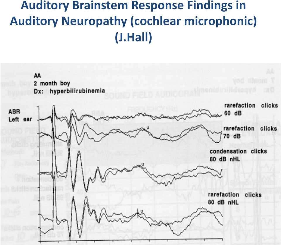 Auditory Neuropathy