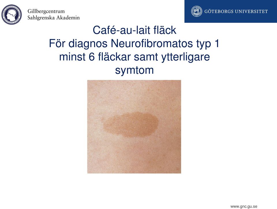 Neurofibromatos typ 1