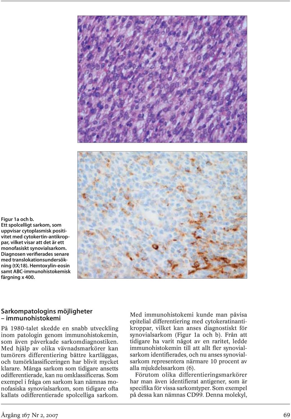 Sarkompatologins möjligheter immunohistokemi På 1980-talet skedde en snabb utveckling inom patologin genom immunohistokemin, som även påverkade sarkomdiagnostiken.