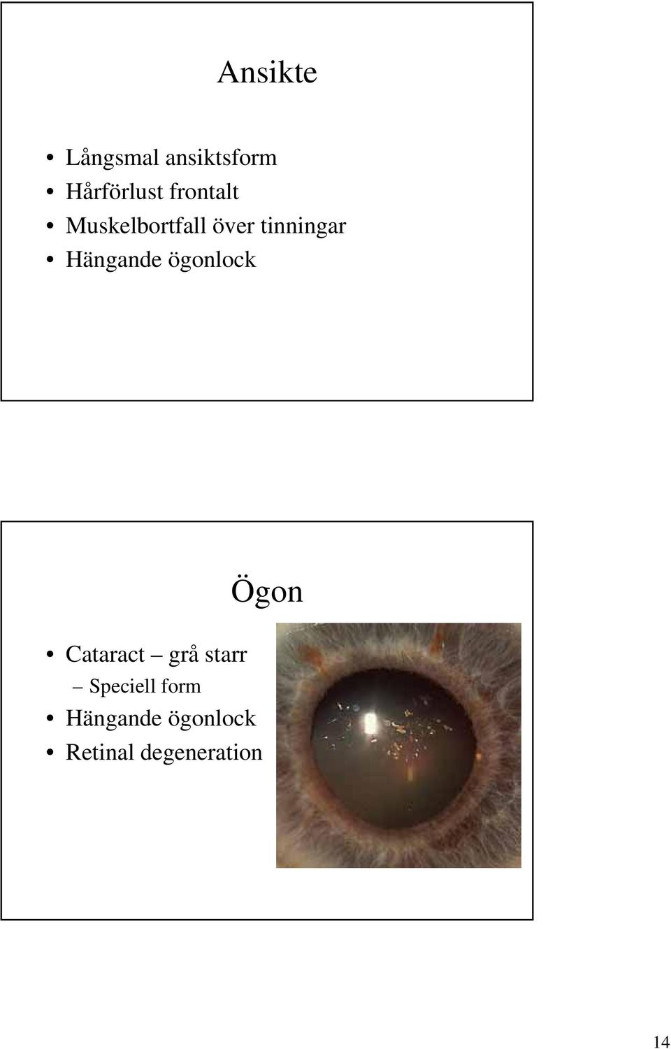 Hängande ögonlock Ögon Cataract grå starr