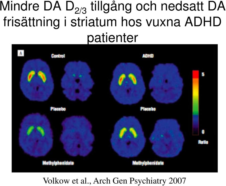 striatum hos vuxna ADHD