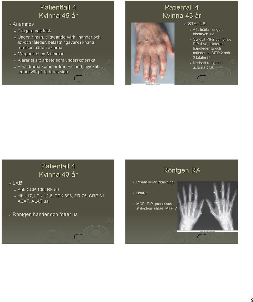 Patienfall 4 Kvinna 43 år STATUS: AT, hjärta, lungor, blodtryck ua Synovit PIP2 och 3 hö, PIP 4 vä, bilateralt i handlederna och fotlederna, MTP 2 och 3 bilateralt.