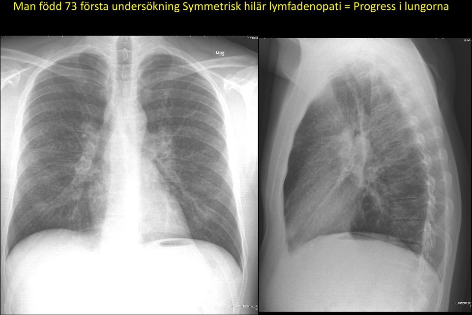 Symmetrisk hilär