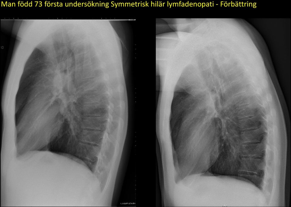 Symmetrisk hilär