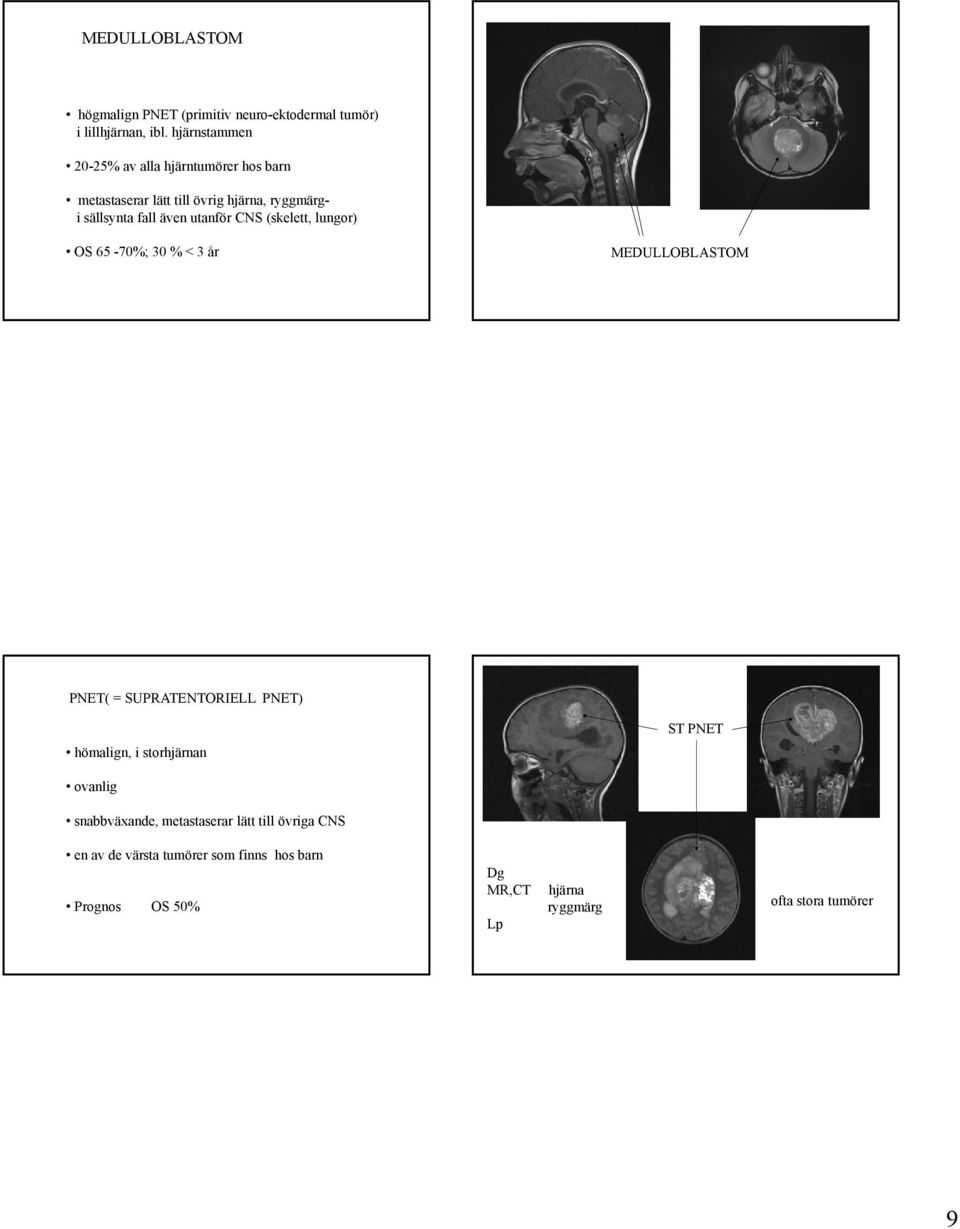 utanför CNS (skelett, lungor) OS 65-70%; 30 % < 3 år MEDULLOBLASTOM PNET( = SUPRATENTORIELL PNET) hömalign, i storhjärnan