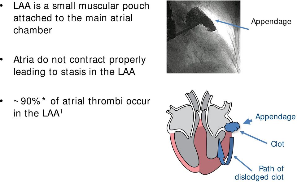 properly leading to stasis in the LAA ~90%* of atrial