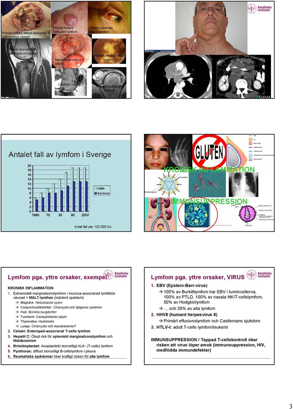 Extranodalt marginalzonslymfom i mucosa-associerad lymfatisk vävnad = MALT-lymfom (indolent sjukdom) Magsäck: Helicobacter pylori Conjunctiva/tårkörtlar: Chlamydia och Sjögrens syndrom Hud: Borrelia