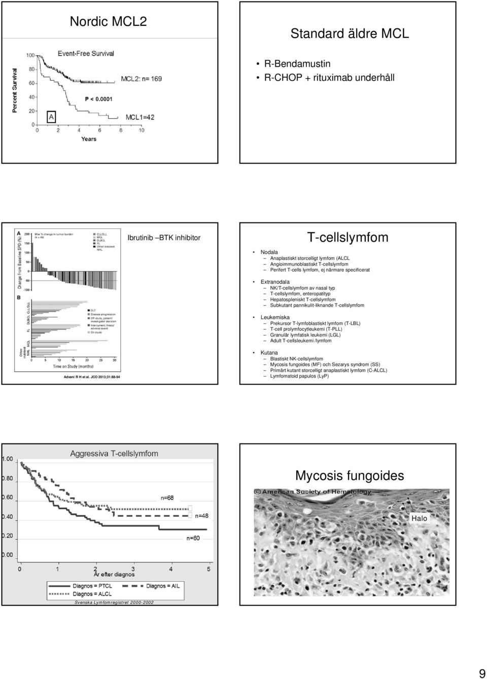 rekursor T-lymfoblastiskt lymfom (T-LBL) T-cell prolymfocytleukemi (T-LL) Granulär lymfatisk leukemi (LGL) Adult T-cellsleukemi /lymfom Advani R et al.