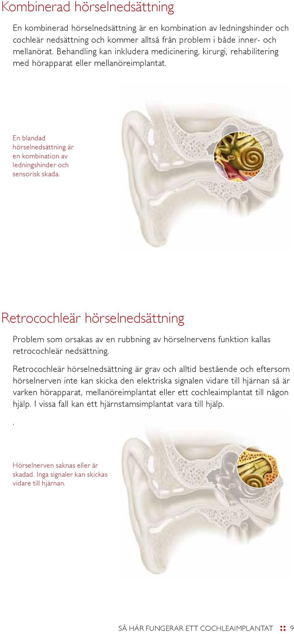 Retrocochleär hörselnedsättning Problem som orsakas av en rubbning av hörselnervens funktion kallas retrocochleär nedsättning.