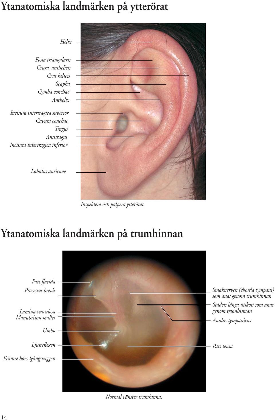 Ytanatomiska landmärken på trumhinnan Pars fl acida Processus brevis Lamina vasculosa Manubrium mallei Umbo Ljusrefl exen Smaknerven (chorda