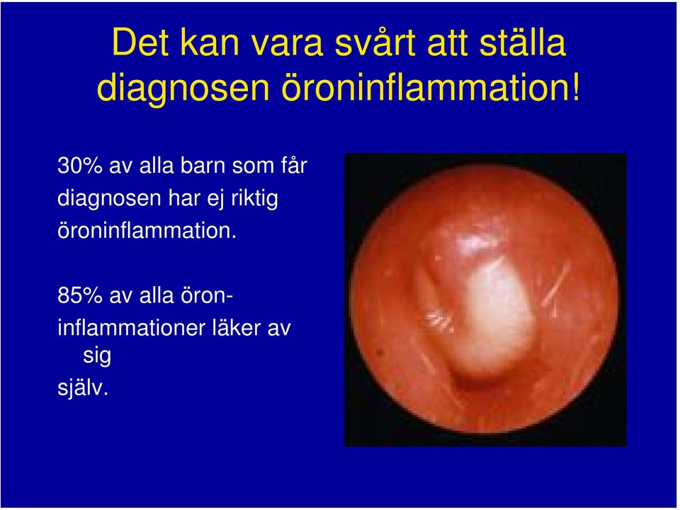 30% av alla barn som får diagnosen har ej