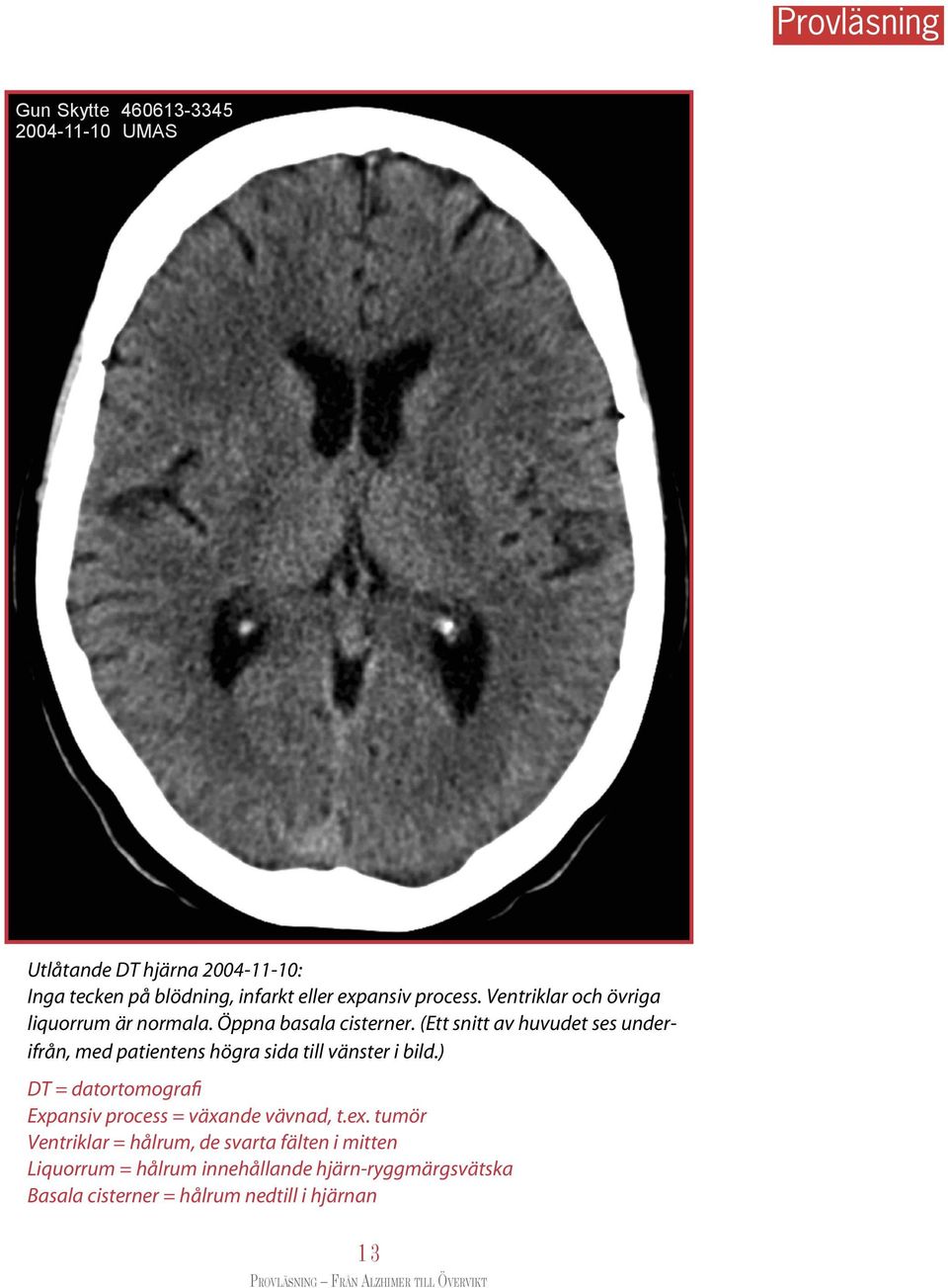 (Ett snitt av huvudet ses underifrån, med patientens högra sida till vänster i bild.