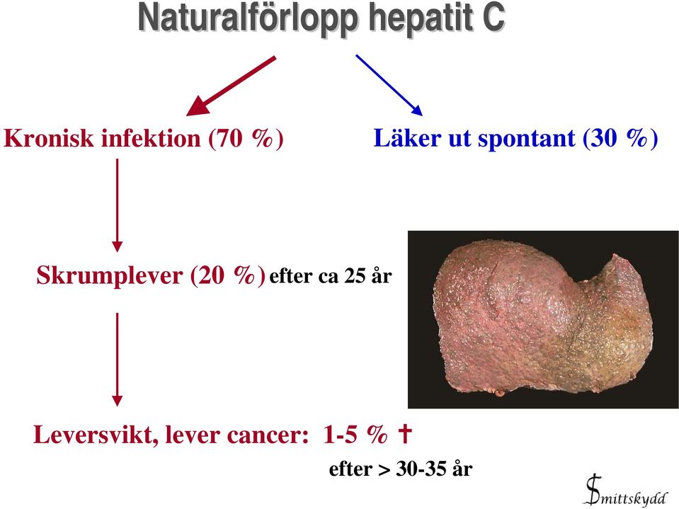 %) Skrumplever (20 %) efter ca 25 år