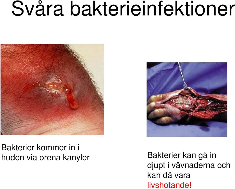 orena kanyler Bakterier kan gå in