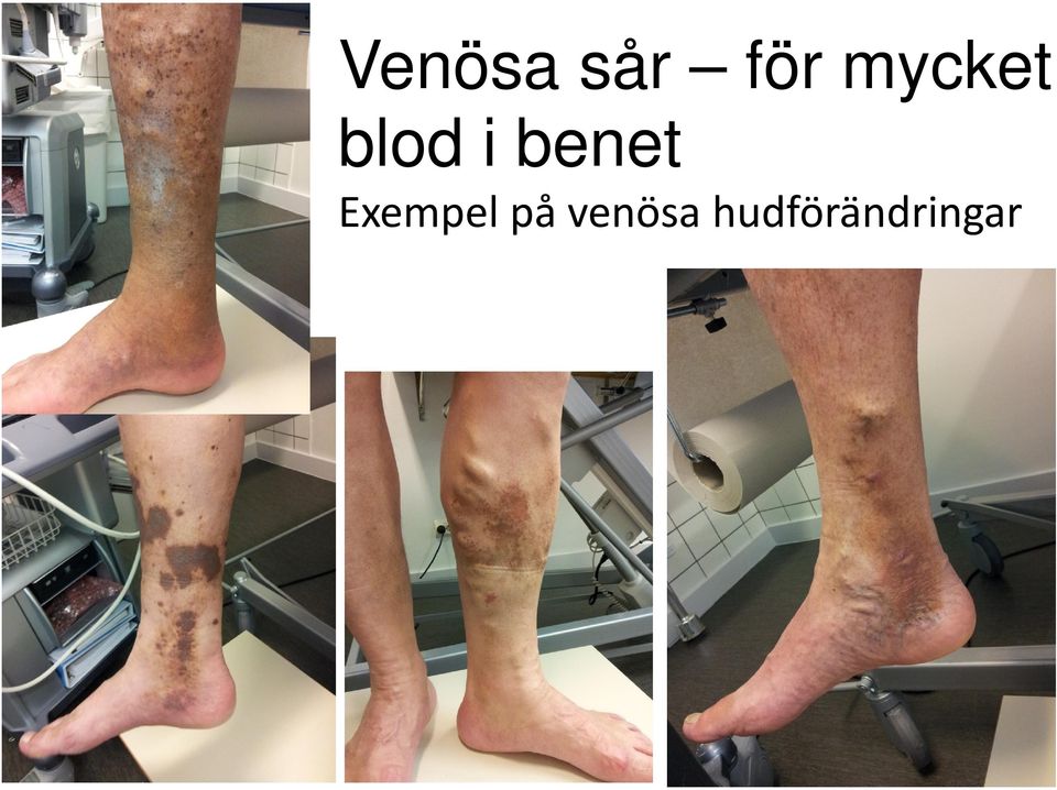 benet Exempel på