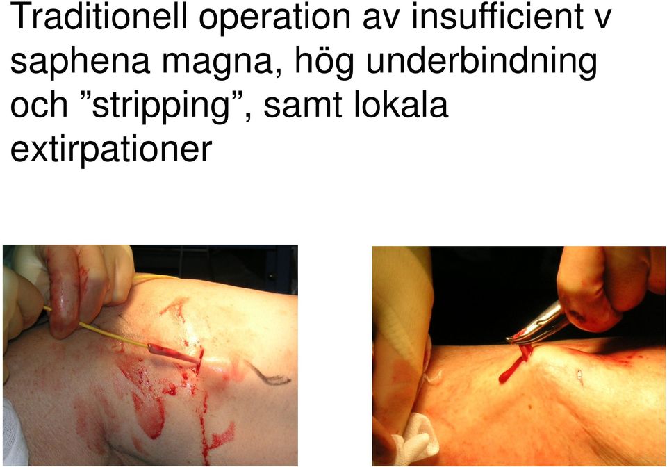 magna, hög underbindning och