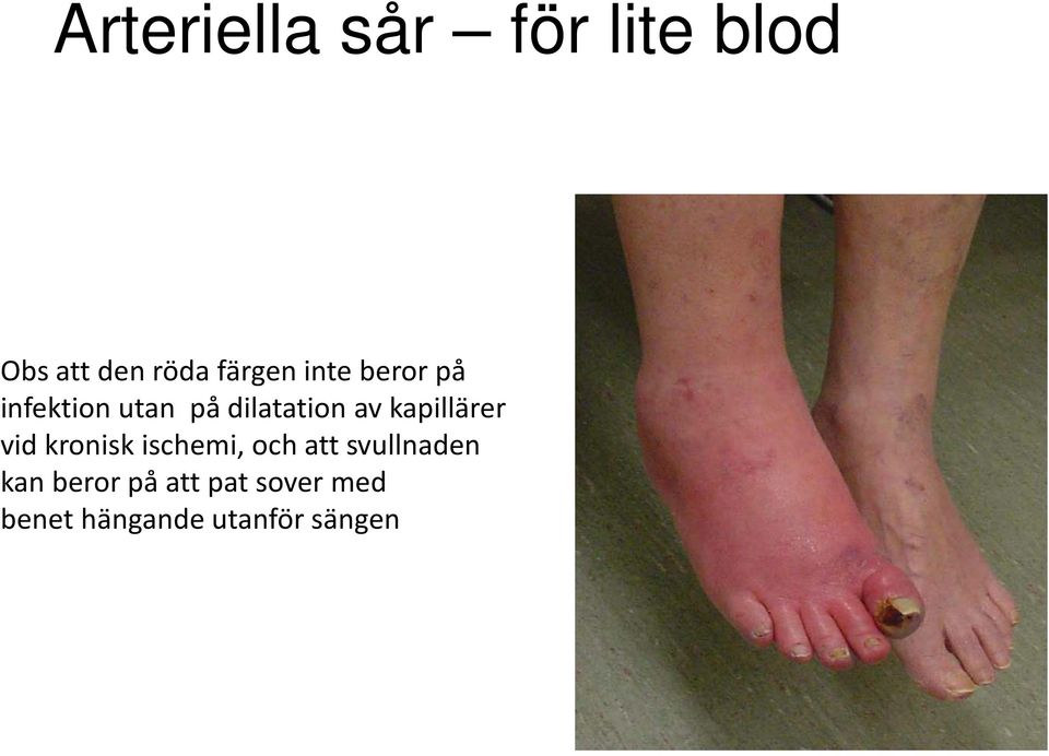 kapillärer vid kronisk ischemi, och att svullnaden