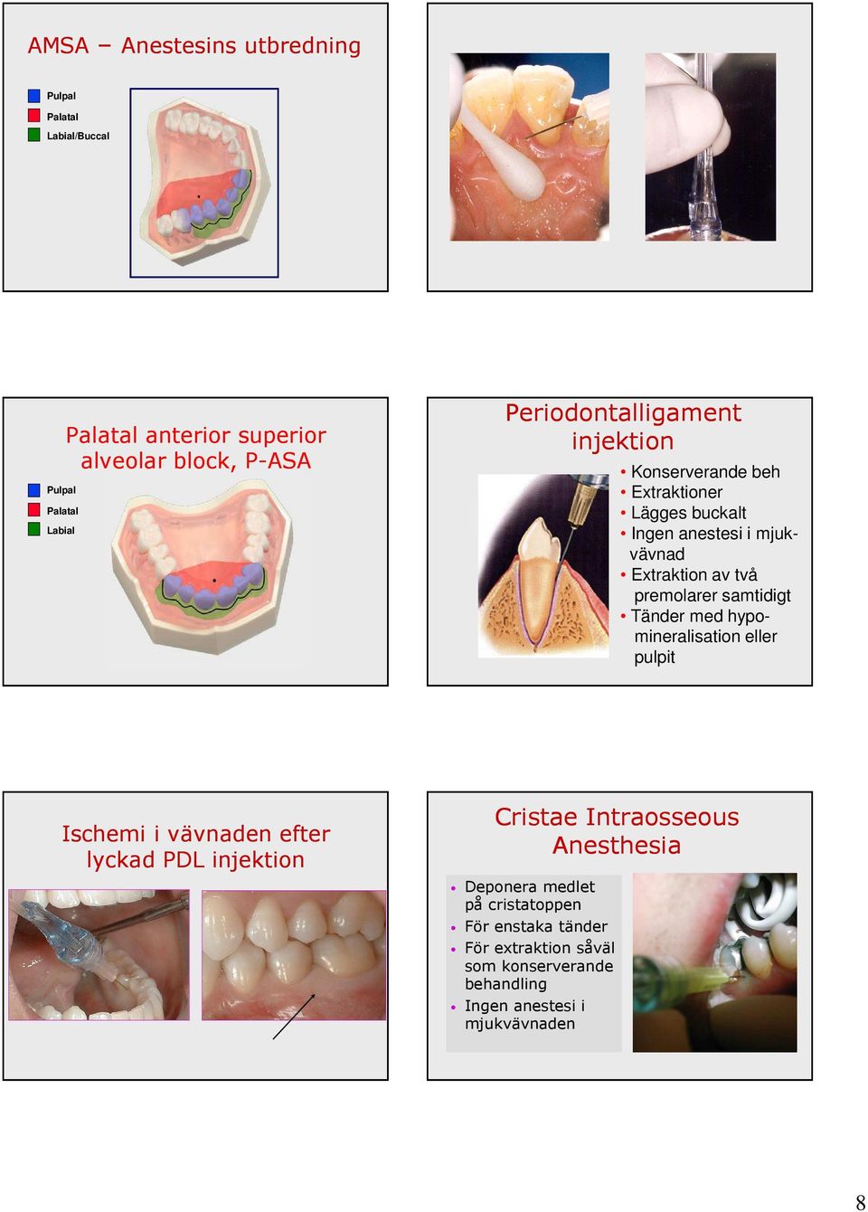 premolarer samtidigt Tänder med hypomineralisation eller pulpit Ischemi i vävnaden efter lyckad PDL injektion Cristae Intraosseous