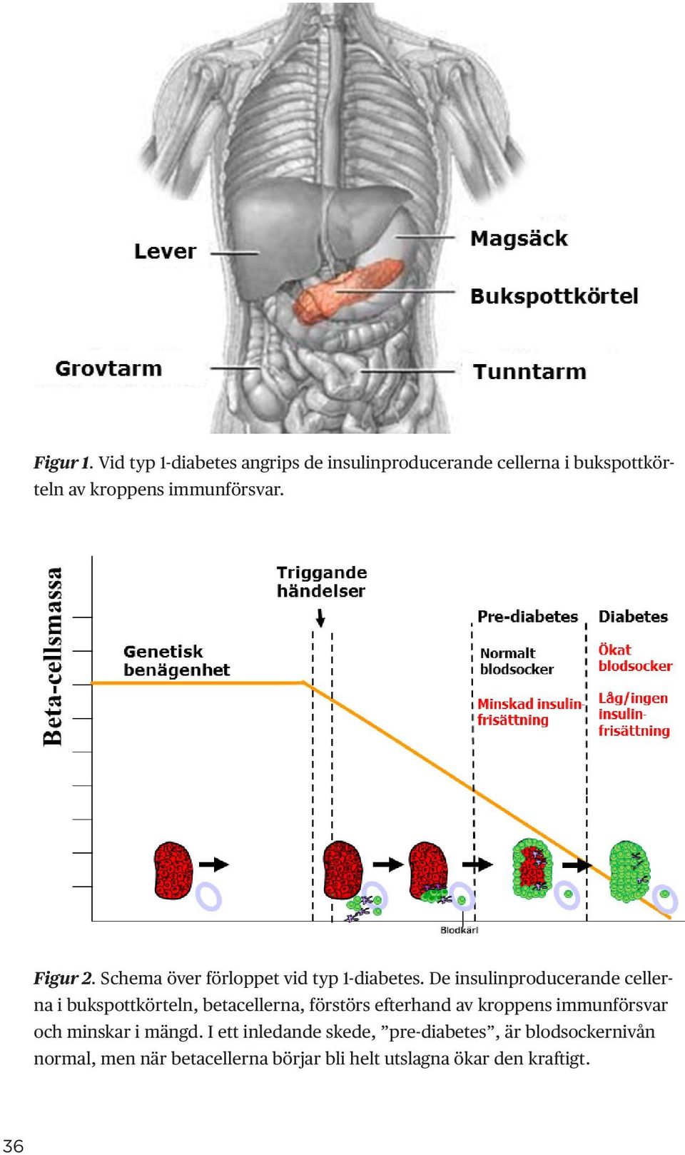 Figur 2. Schema över förloppet vid typ 1-diabetes.