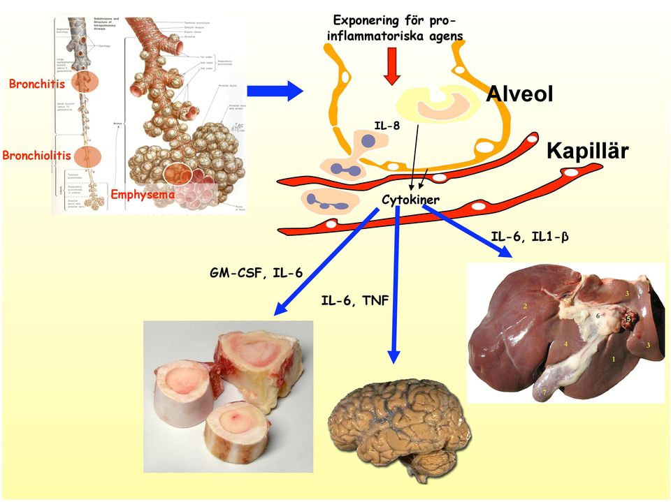 IL-8 Alveol Kapillär Emphysema