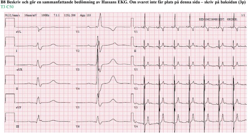 Hassans EKG.