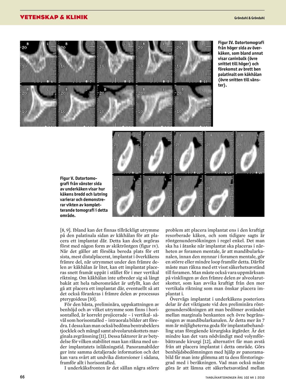 Datortomografi från vänster sida av underkäken visar hur käkens bredd och lutning varierar och demonstrerar vikten av kompletterande tomografi i detta område. [8, 9].