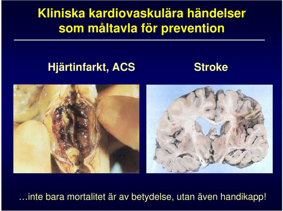 Hjärtinfarkt, ACS Stroke inte bara