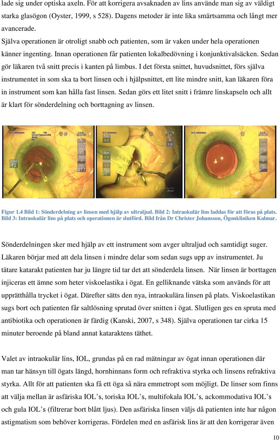 Sedan gör läkaren två snitt precis i kanten på limbus.