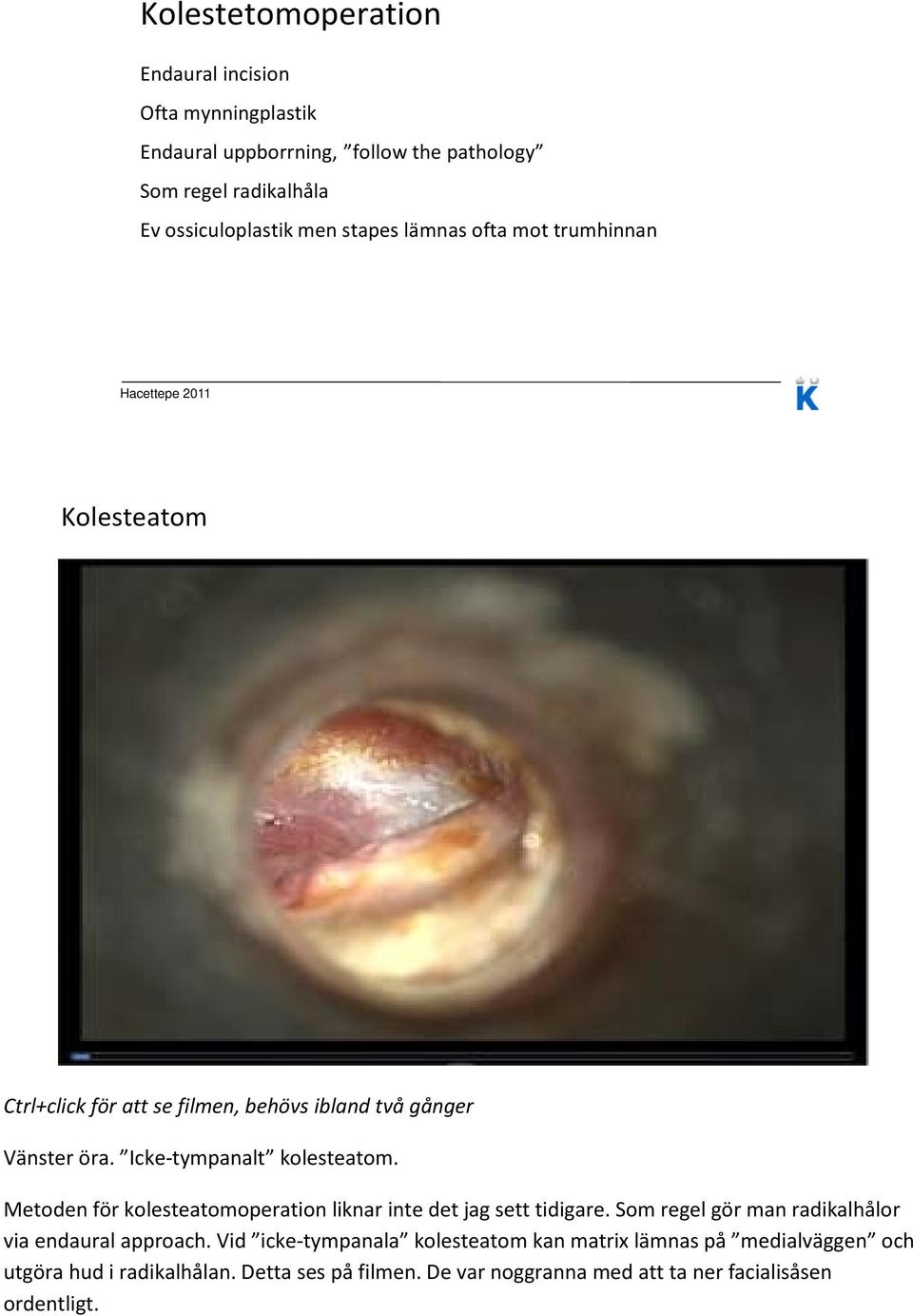 Icke-tympanalt kolesteatom. Metoden för kolesteatomoperation liknar inte det jag sett tidigare. Som regel gör man radikalhålor via endaural approach.