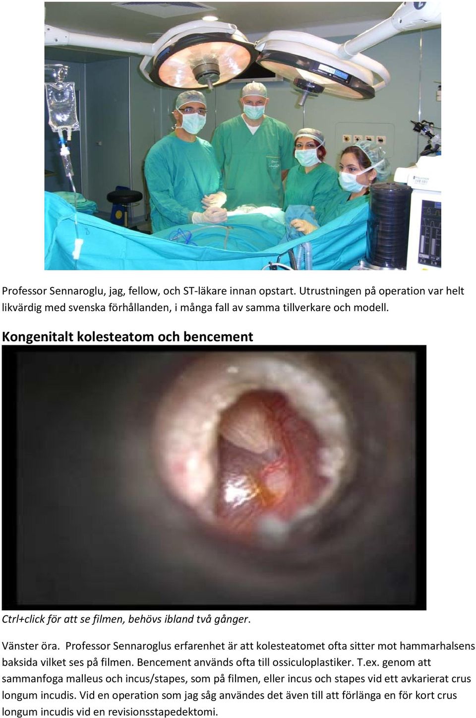 Kongenitalt kolesteatom och bencement Ctrl+click för att se filmen, behövs ibland två gånger. Vänster öra.
