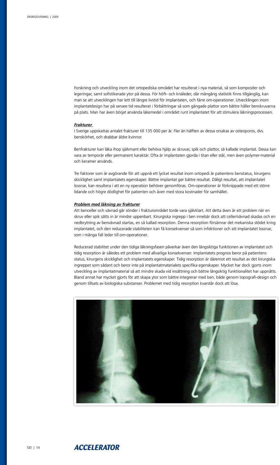 Utvecklingen inom implantatdesign har på senare tid resulterat i förbättringar så som gängade plattor som bättre håller benskruvarna på plats.